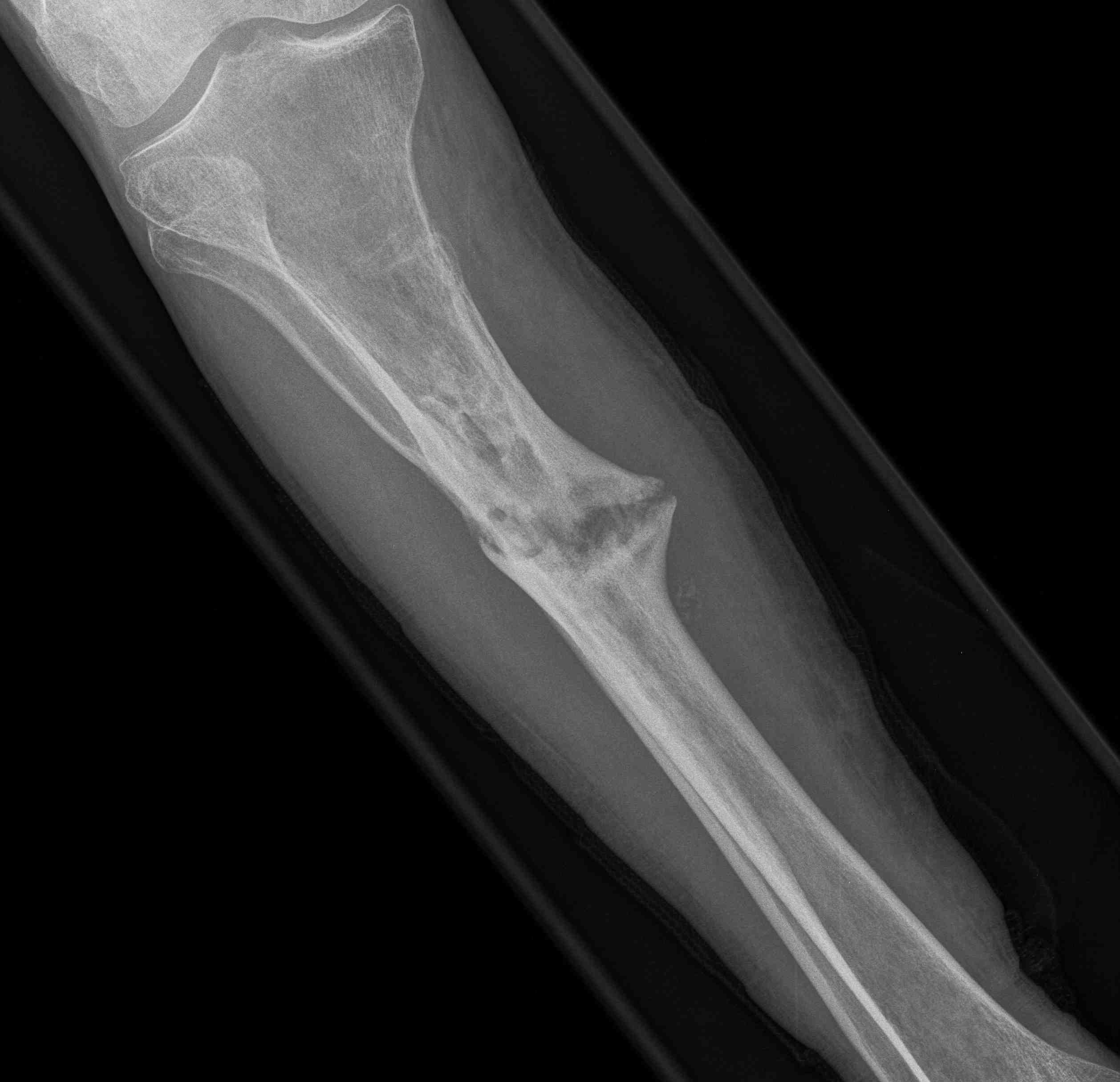 Tibial Hypertrophic Nonunion 